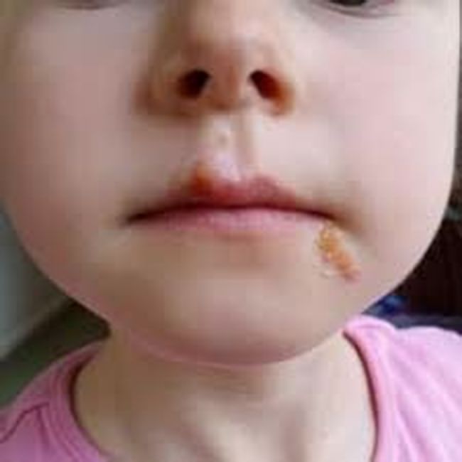 تبخال دهان در کودکان و علائم آن