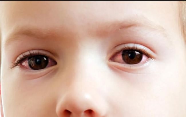 قرمزی چشم در کودکان و علائم آن